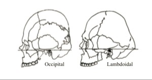 Diagram-Lambdoid and Occipital